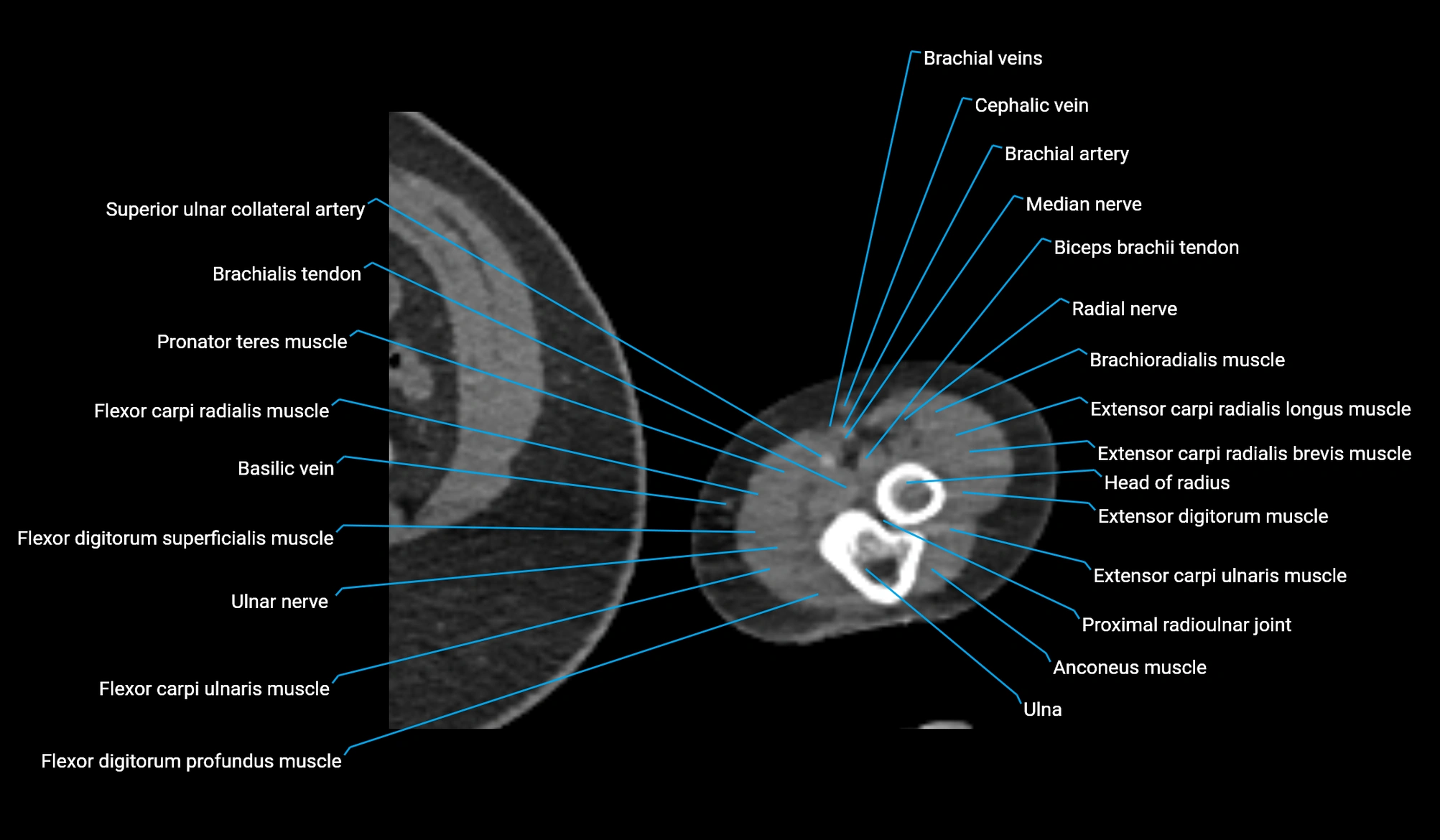 CT upper arm axial  cross sectional anatomy labelled radiology image -00408.webp